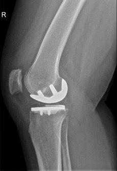 Knie Prothese Of Nieuwe Knie | Orthopedie Izegem